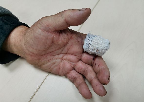 Серовчанин благодарит медиков за помощь. Мужчина случайно отрезал себе палец